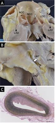 Case Report: Molecular autopsy underlie COVID-19-associated sudden, unexplained child mortality